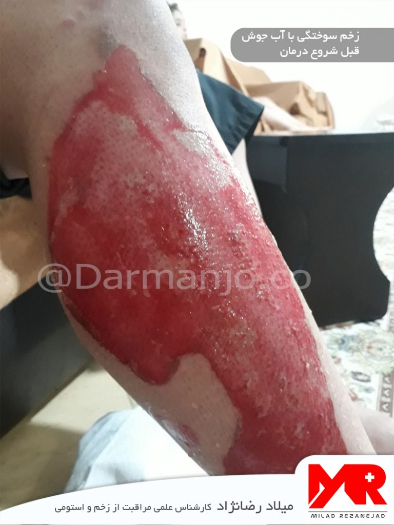 درمان سوختگی با آب جوش