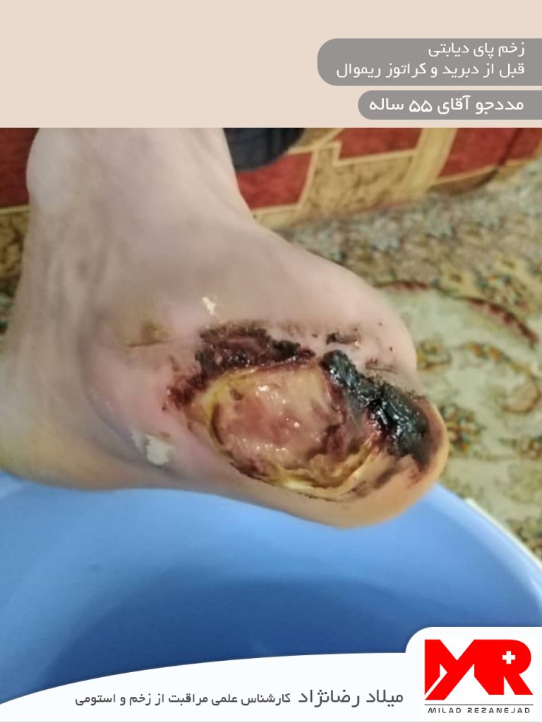 زخم پای دیابتی