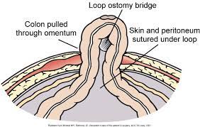 Pin de Ernie Wadsworth em Lower Gastrointestinal Abnormalities | Curativo