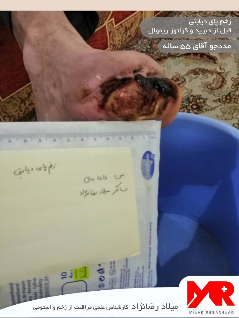 زخم پای دیابتی