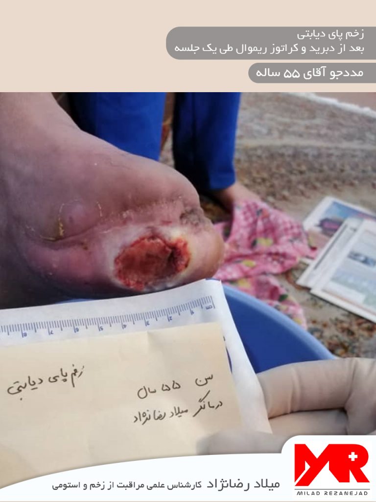 زخم پای دیابتی