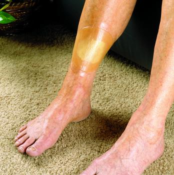 https://www.indemedical.com/assets/images/woundcare/mmm90002.jpg