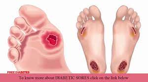 Diabetic Sores - Heal Diabetes Sore Very Fast - YouTube