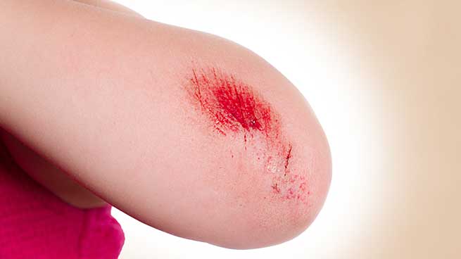 تشریح مراحل بهبود زخم