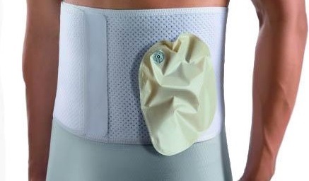 استوما، کلوستومی و یوروستومی چیست؟