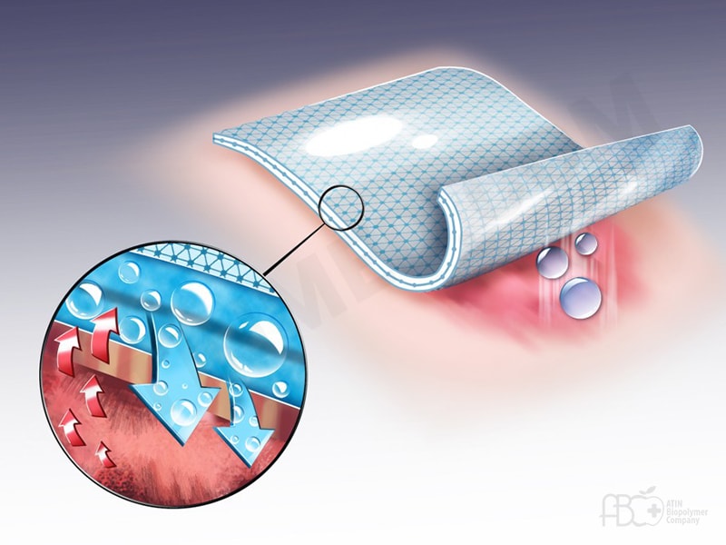 پانسمان نوین و جایگاه استفاده آن