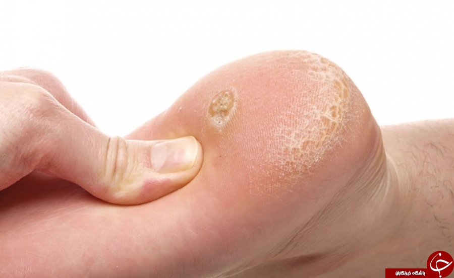 میخچه و پینه کف پا